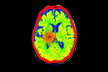 A brain scan shows blood flow where a stroke took place. Stroke is a common cause of coma.